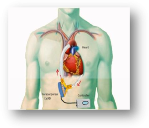 Para-Corporeal Left Ventricular Assist Device